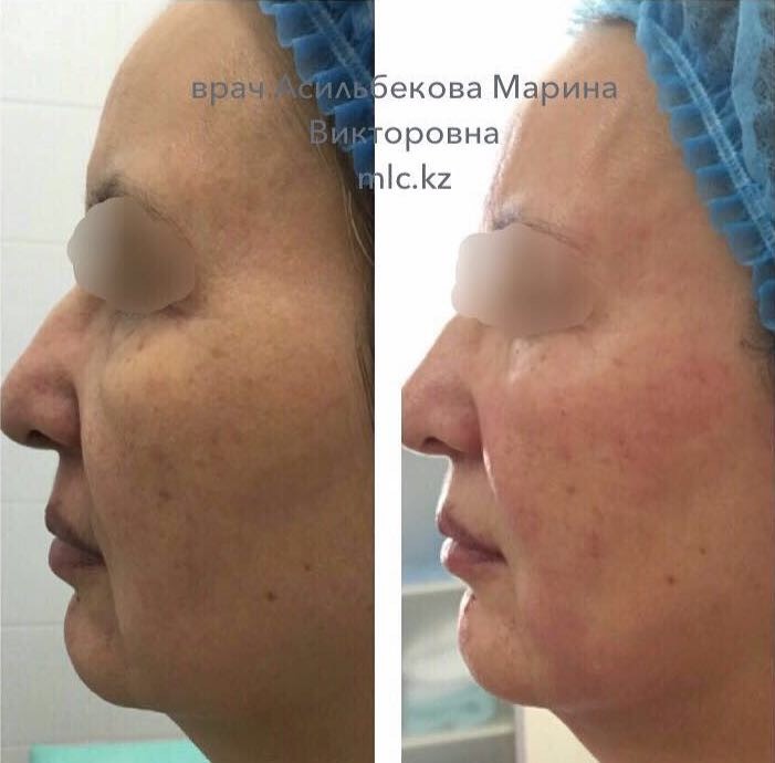 Устранение дряблости кожи