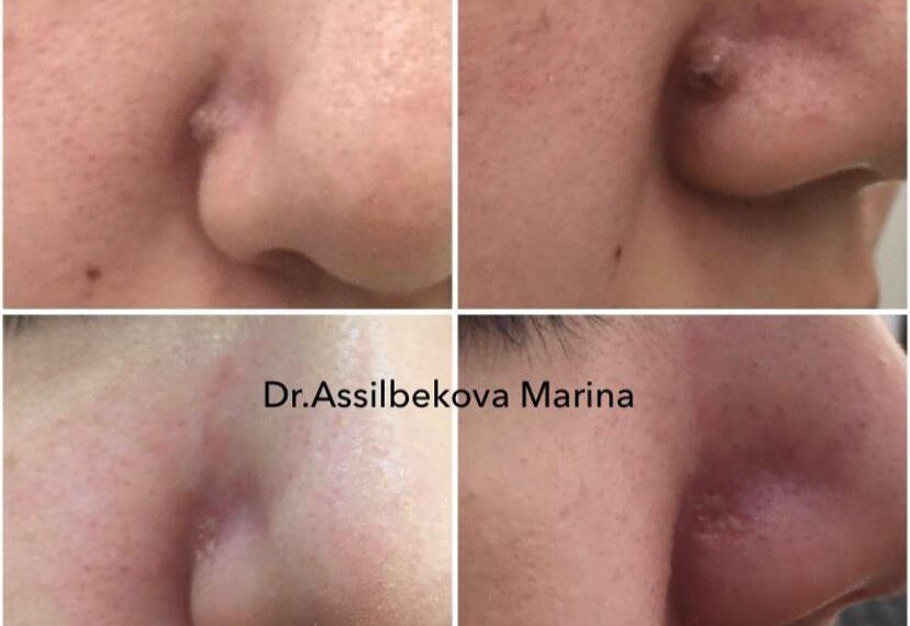 фото удаления родинки на носу у мужчины