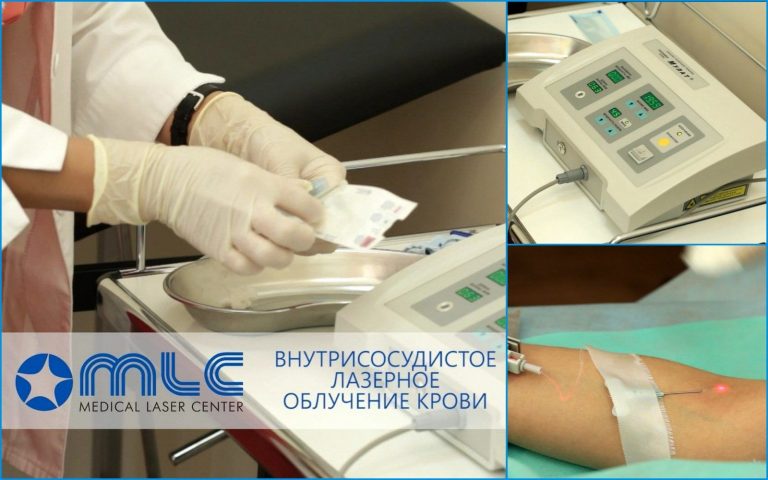 Внутривенное лазерное облучение крови (ВЛОК)