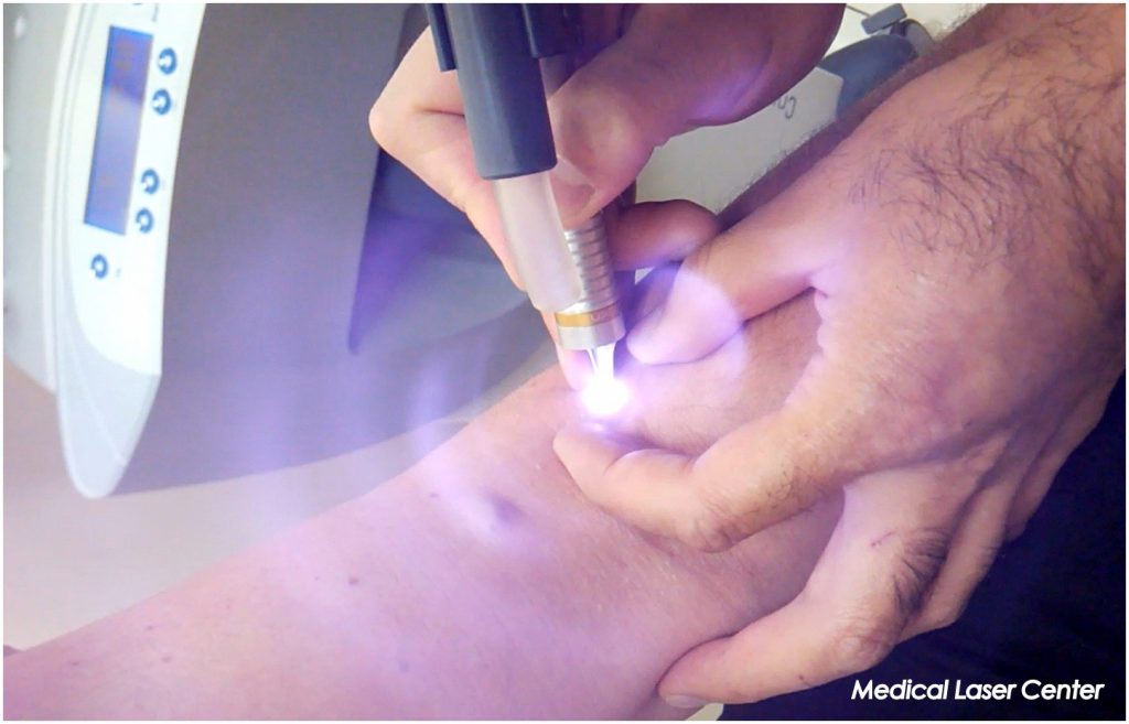 Лазерное удаление и лечение гемангиом