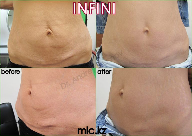 Коррекция растяжек лазером