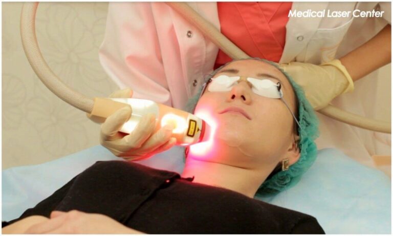 Лазерная эпиляция подбородка: удаление волос