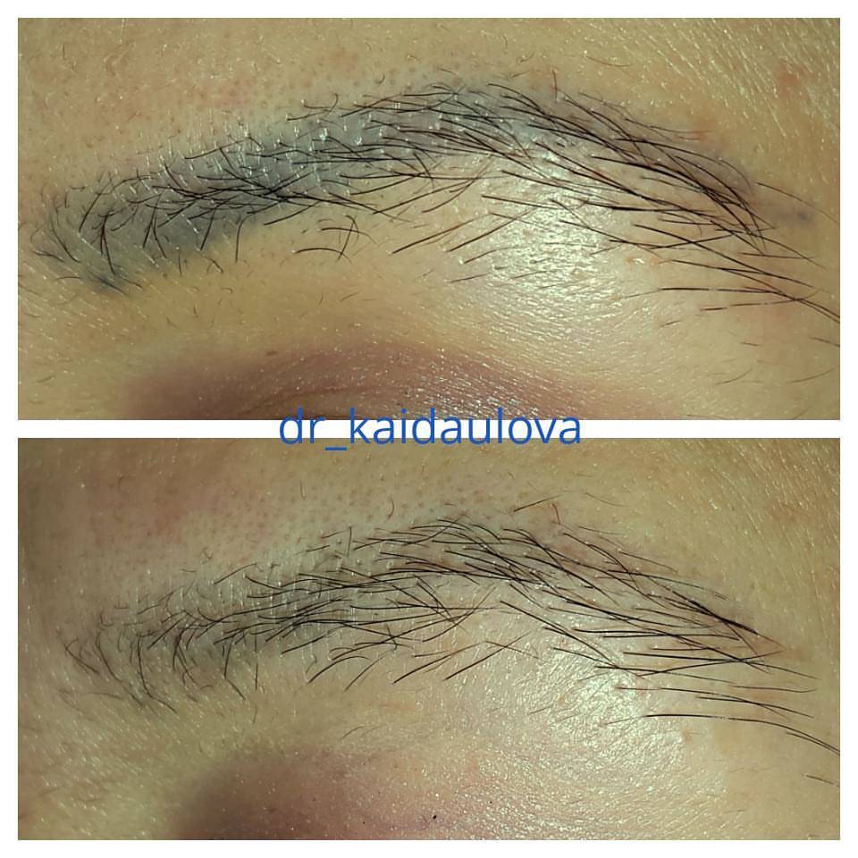 Удаление татуажа лазером