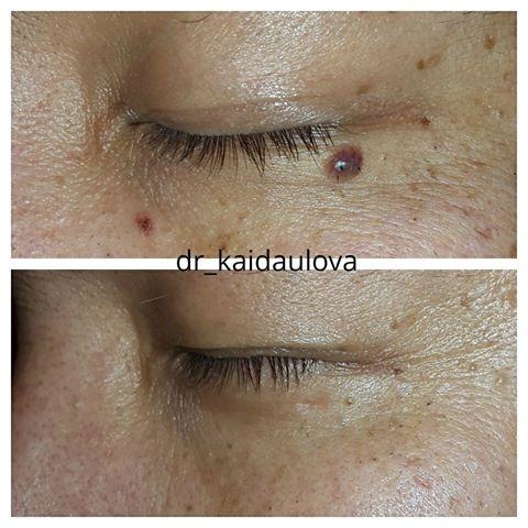 Красные родинки на теле, причины появления и как их удалить