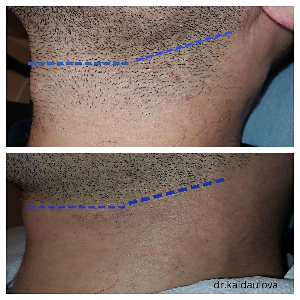 Промежуточный результат лазерной эпиляции