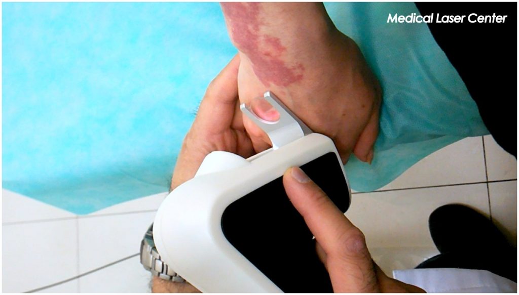 Лазерное удаление гемангиом на аппарате Dornier Medilas, Asclepion QuadroStarPro Yellow