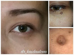 Можно ли удалять родинки