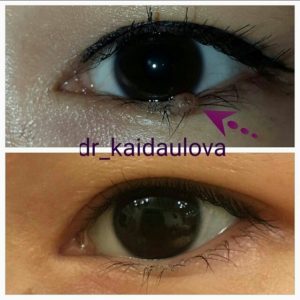 Можно ли удалять родинки