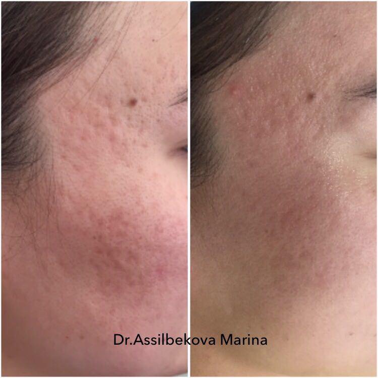 Лазерное ремоделирование ("шлифовка") рубцов постакне (после угревой болезни).