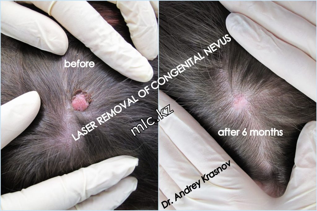 Лазерное удаление родинки (результат после 6 месяцев)