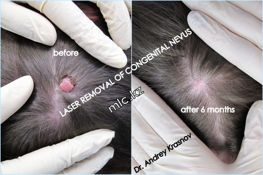 лазерное удаление родинки (результат после 6 месяцев)