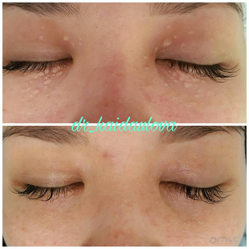 Лазерное удаление сирингом Лазерное удаление сирингом