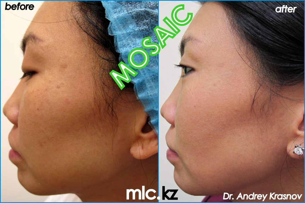 Результаты MOSAIC через 2 недели