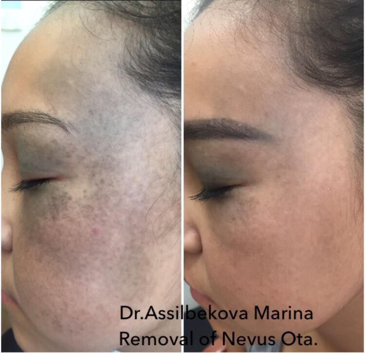 Удаления невуса Ота