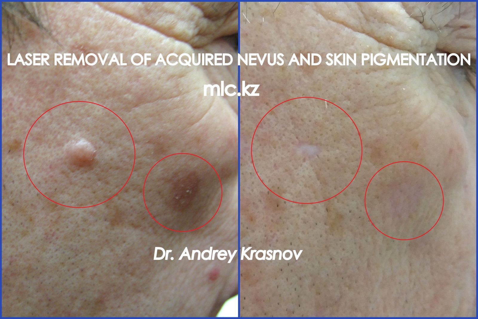 Лазерное удаление родинки на лице, медицинский лазерный центр, Алматы, Краснов Андрей Вячеславович