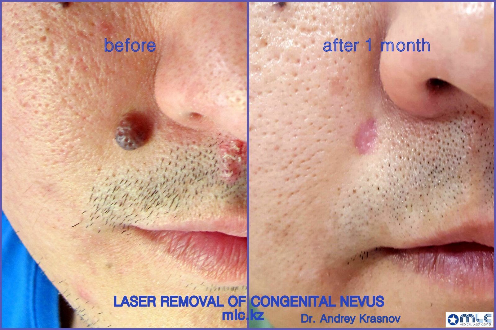Лазерное удаление невуса, медицинский лазерный центр, Алматы, Краснов Андрей Вячеславович