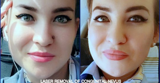 Удаление "родинок"