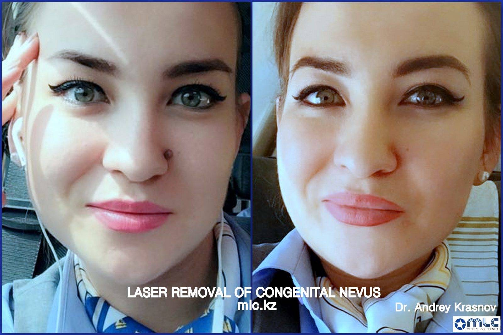 Лазерное удаление родинки на лице, дерматоскопия, медицинский лазерный центр, Краснов Андрей Вячеславович, Алматы
