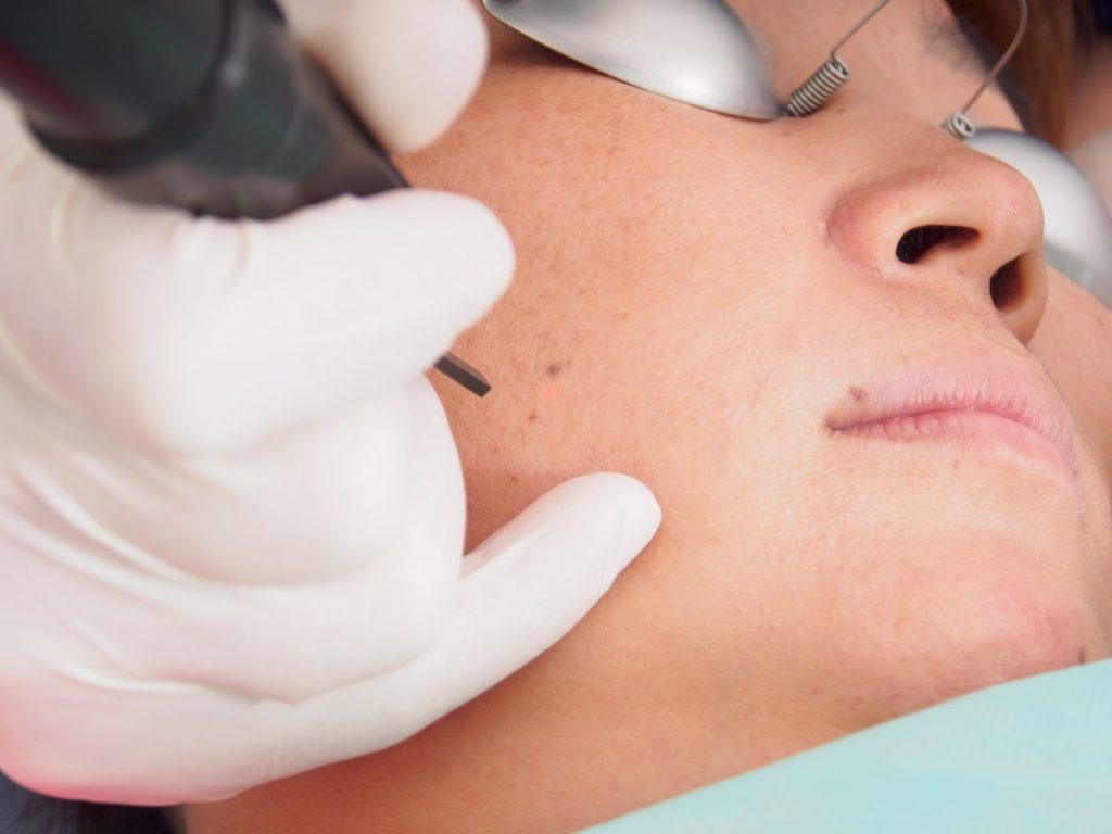 Какие родинки опасны