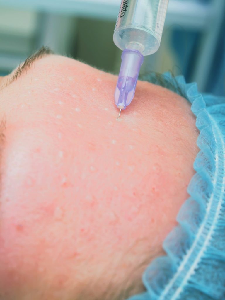 Биоревитализация или мезотерапия