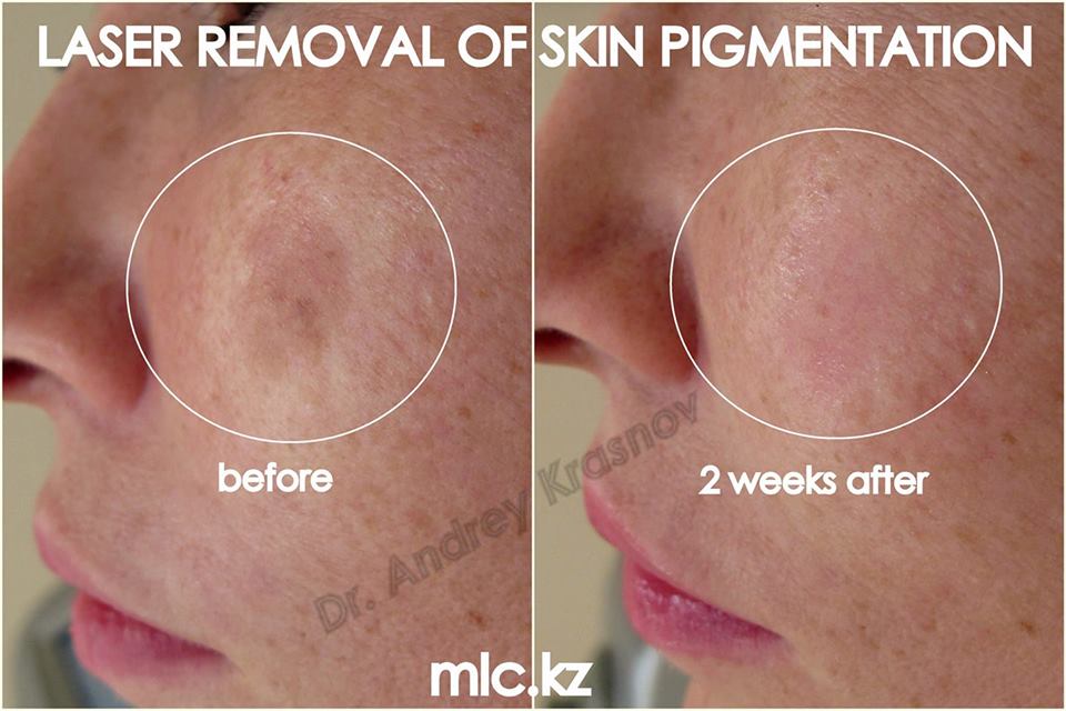 Зима - время для пигментации