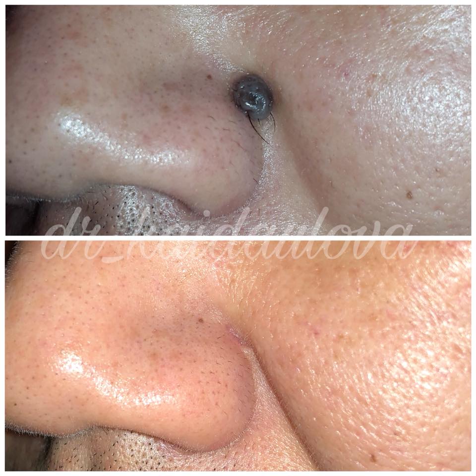 Какие родинки опасны