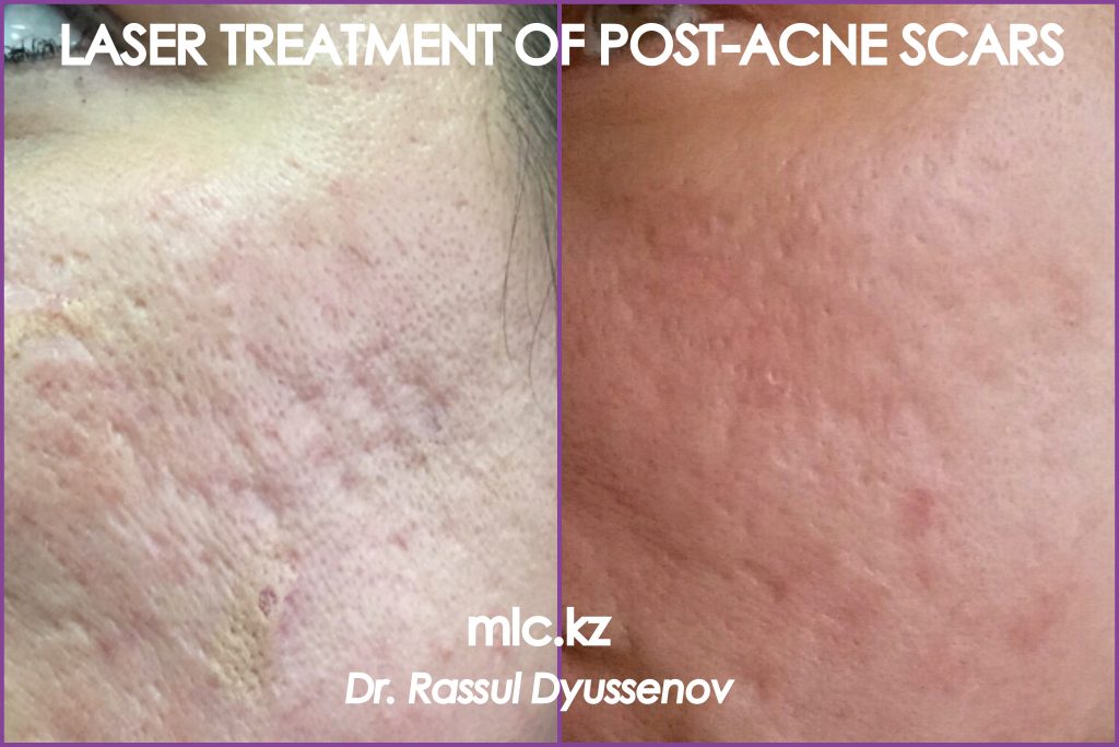 Лазерная шлифовка рубцов постакне
