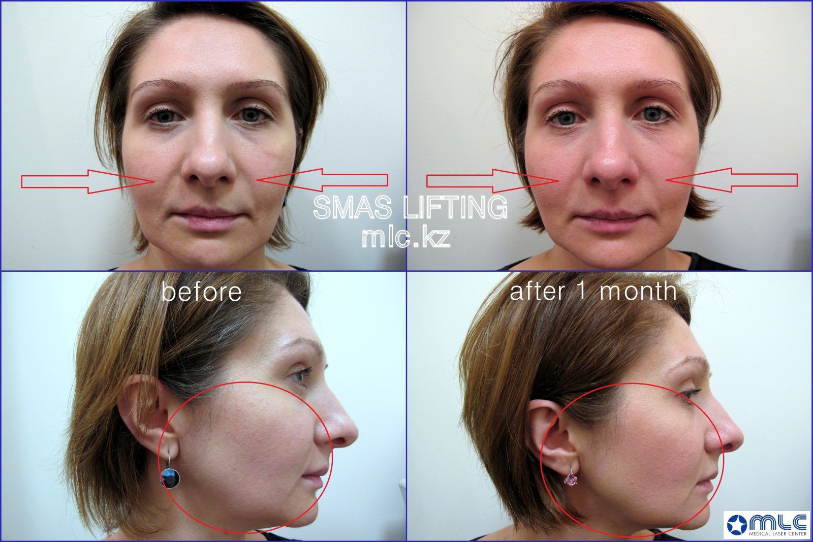 Результат СМАС лифтинга, результат безоперационной подтяжки лица на аппарате ULTRAFORMER, медицинский лазерный центр