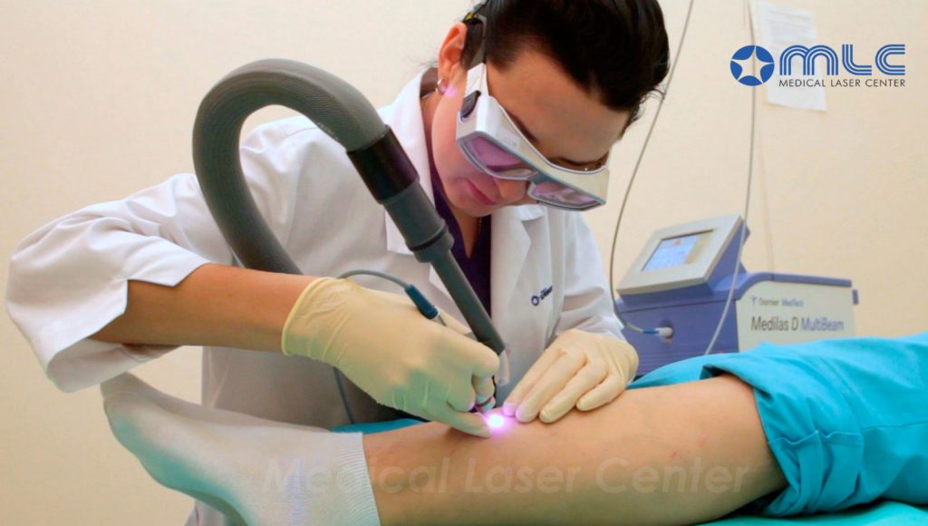 Как убрать сосудистые звездочки на ногах