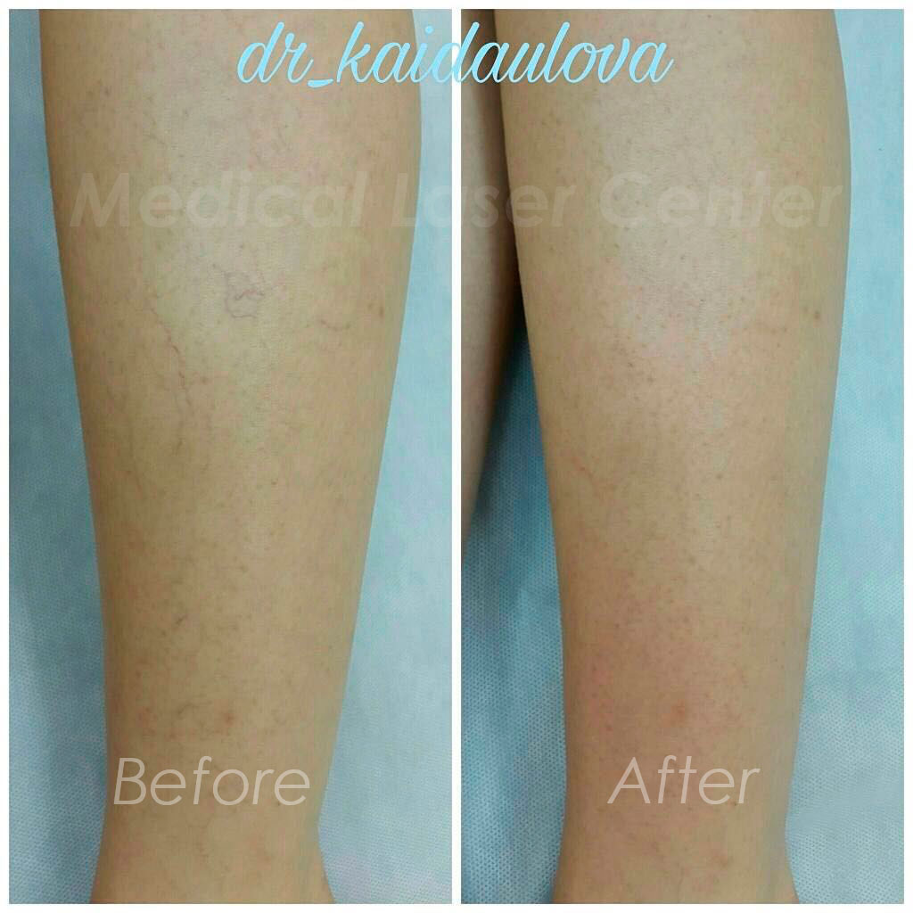 Сосуды - до и после