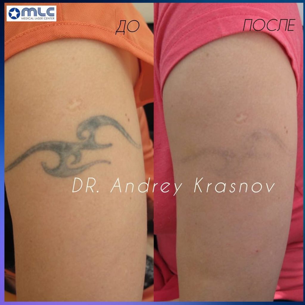 Удаление тату