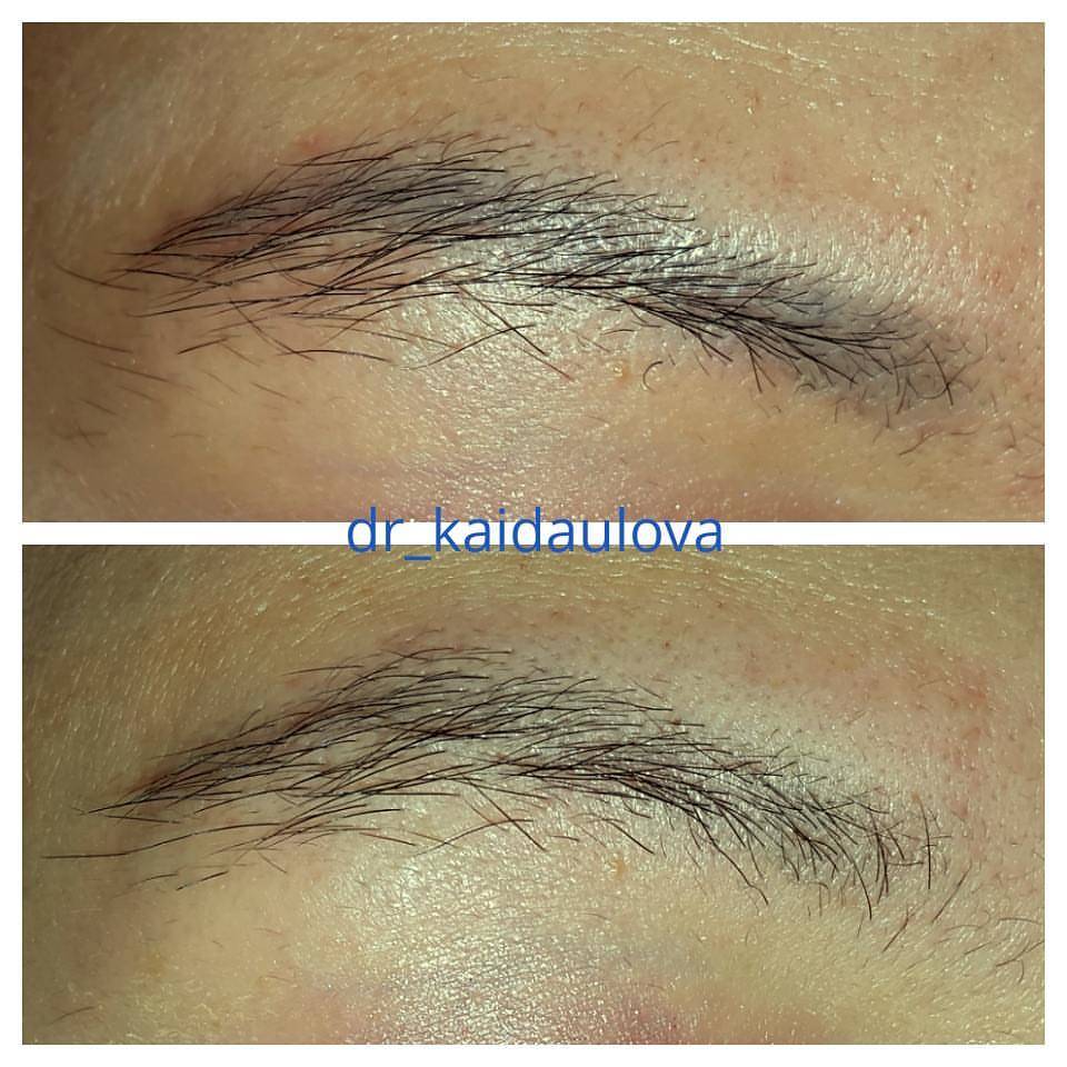 Как удалить татуаж