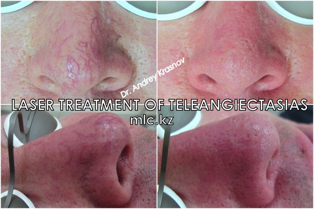 Лазерное лечение телеангиэктазии
