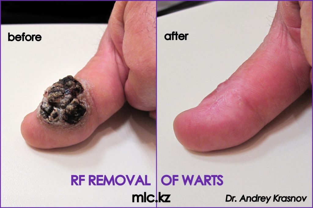 ВПЧ у мужчин: так ли страшен «черт», как его малюют?