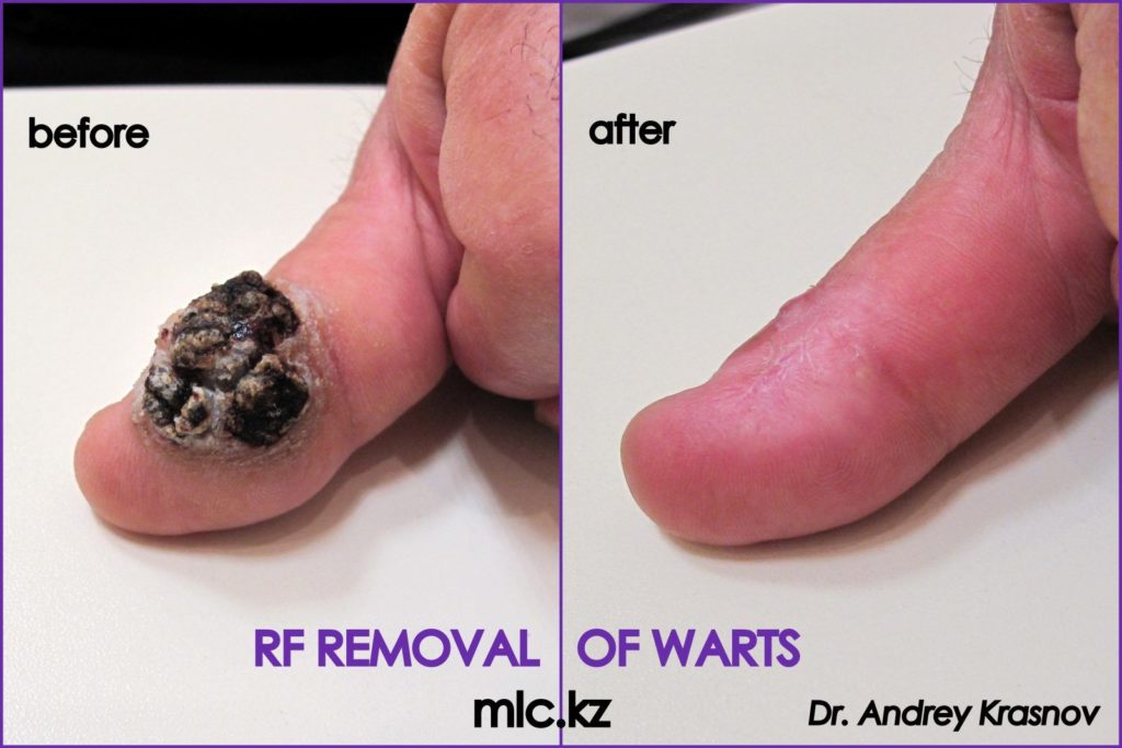 Удаление бородавки