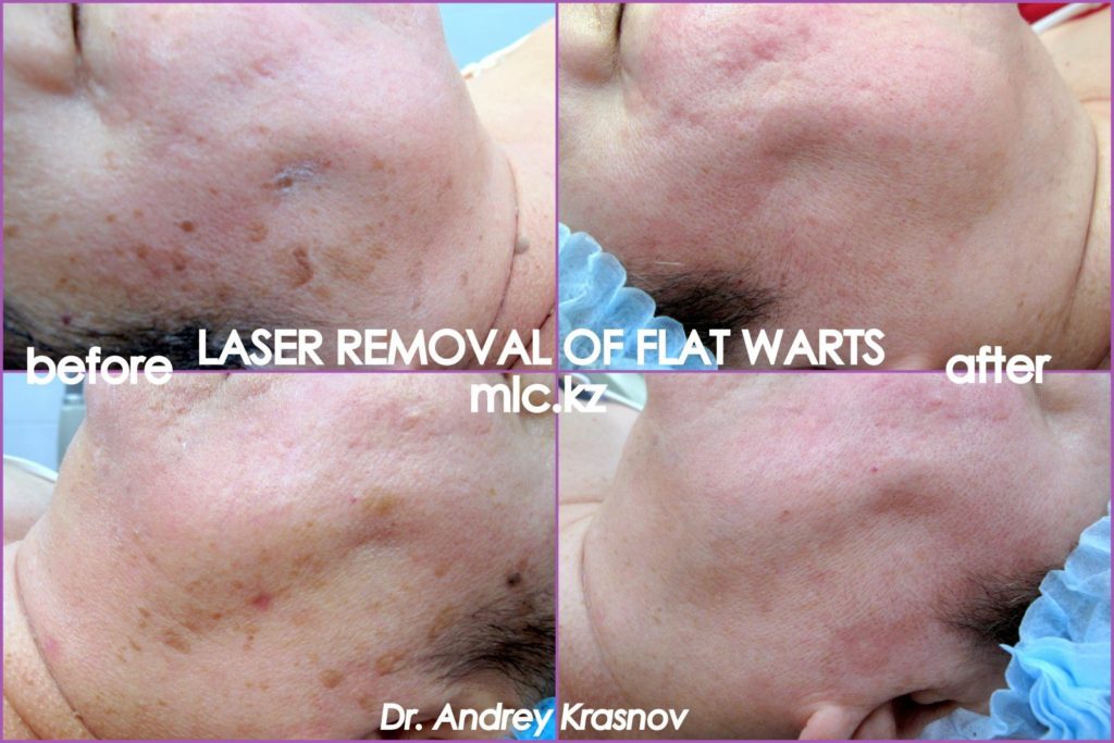 Удаление плоских бородавок 2