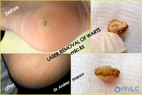 Удаление подошвенных бородавок_logo