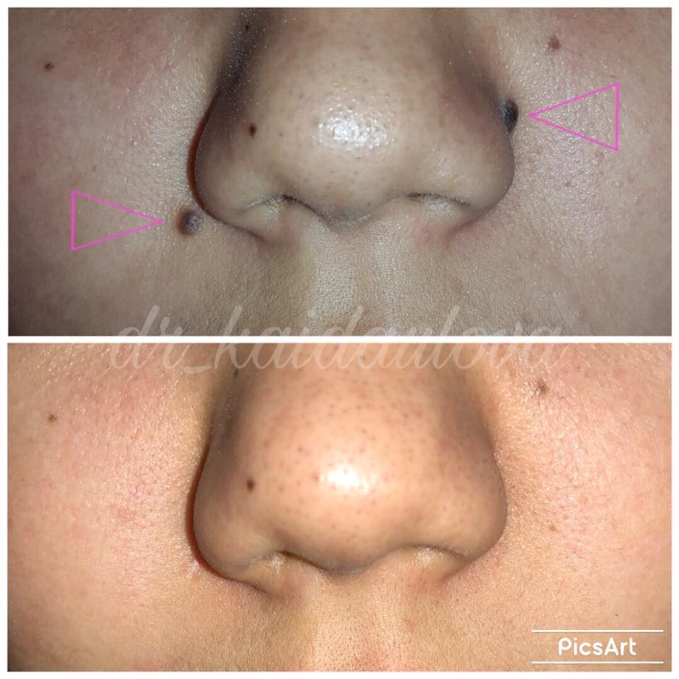 Какие родинки опасны