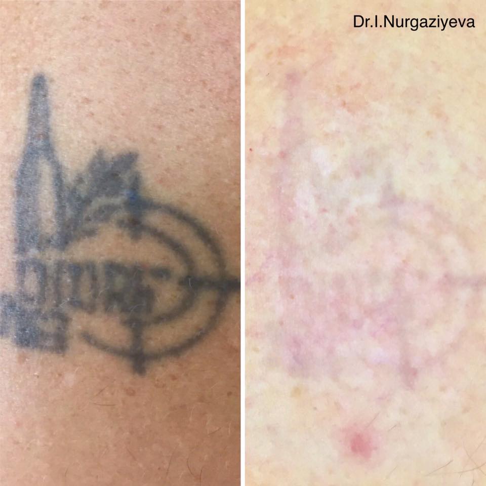 Удаление татуировок