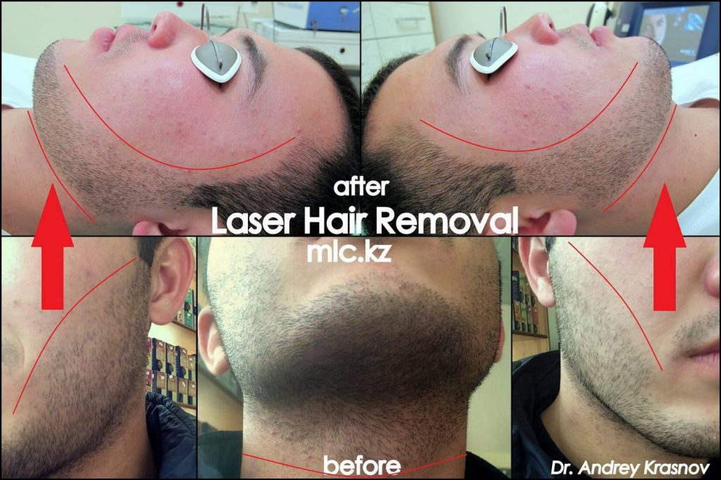 Лазерная эпиляция бороды