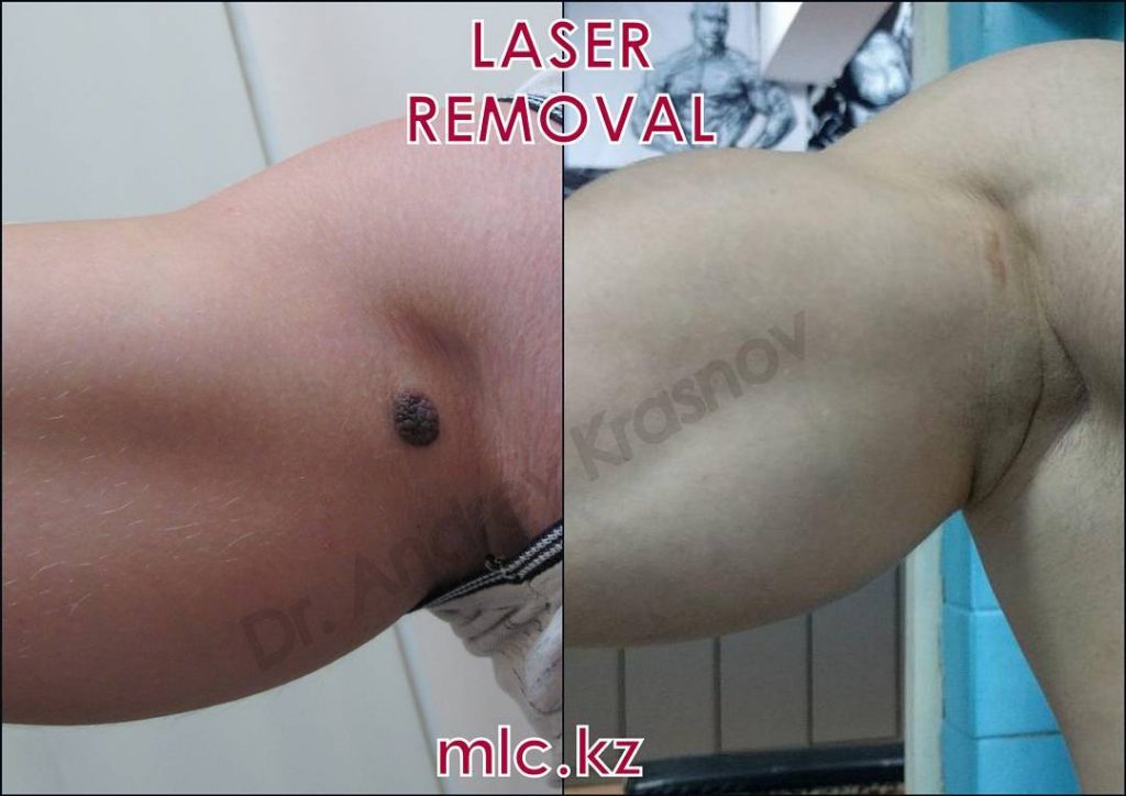 Удаление родинки на бицепсе