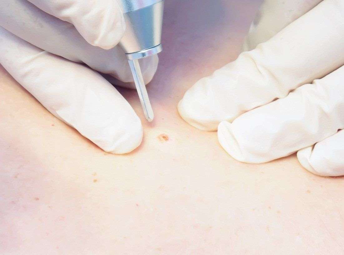 Лазерная дерматология